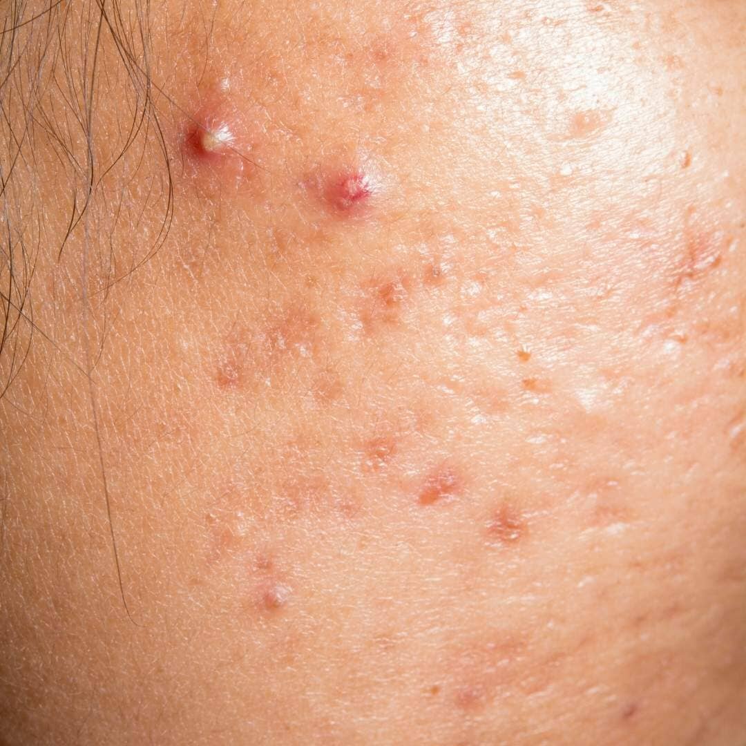 Acne &amp; Blemish