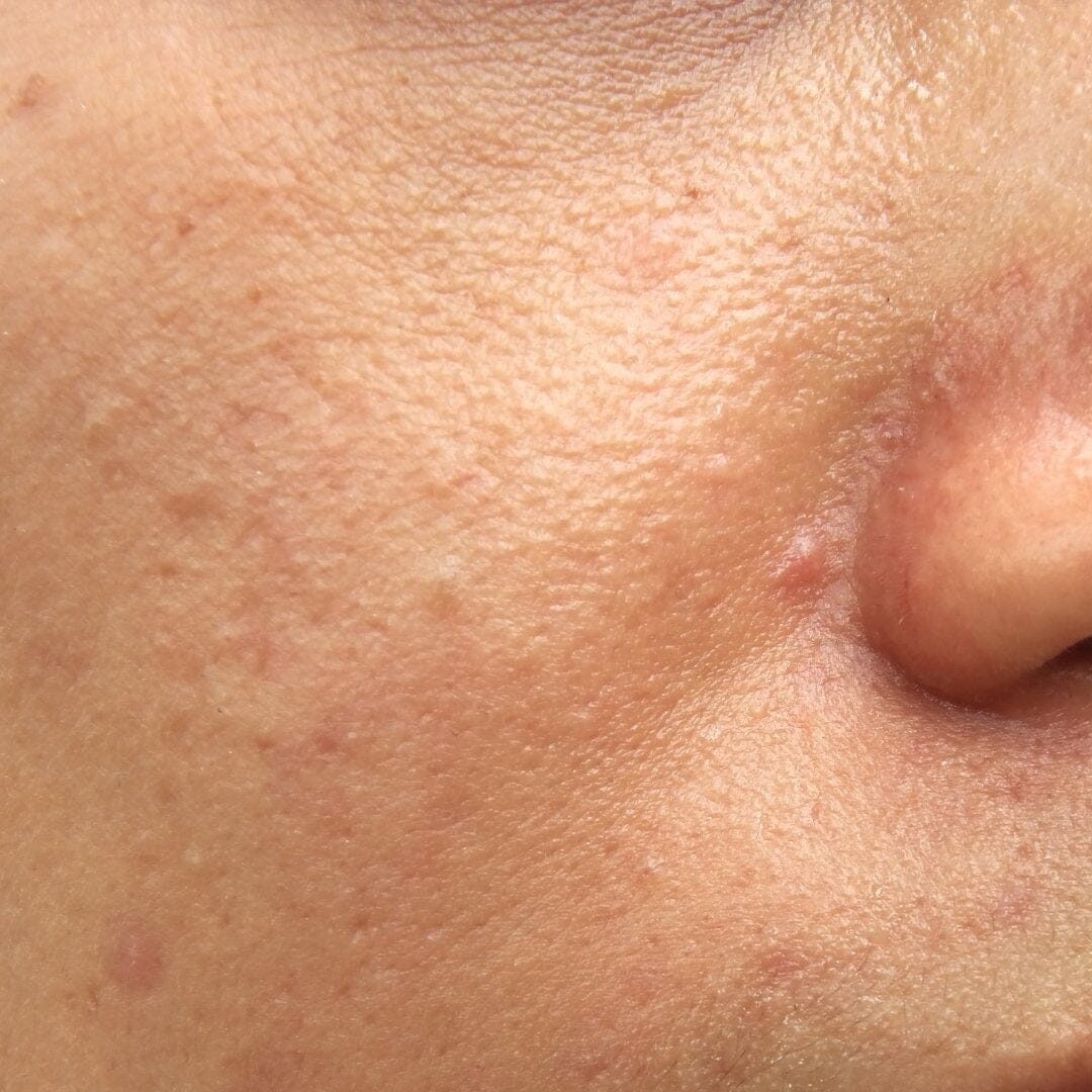 Combination Skin