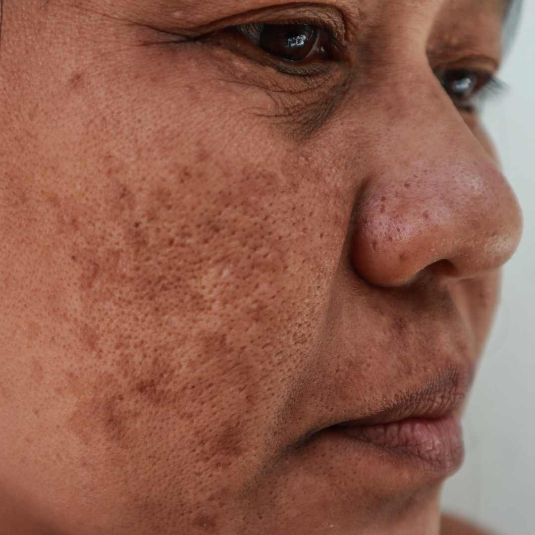 Dark Spots
