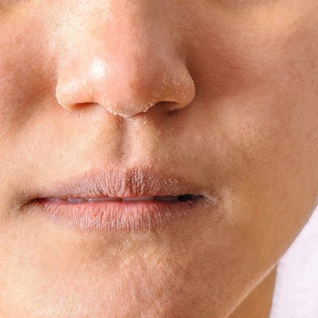 Dry Skin