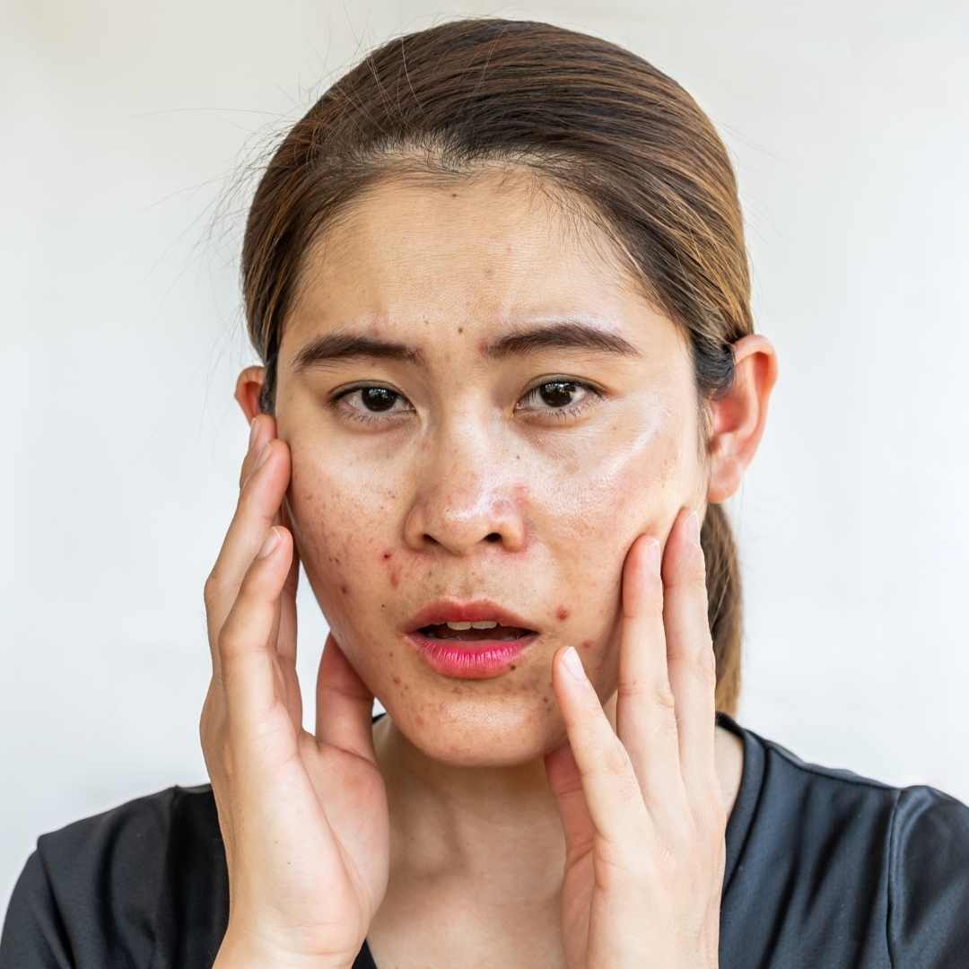 Oily Skin