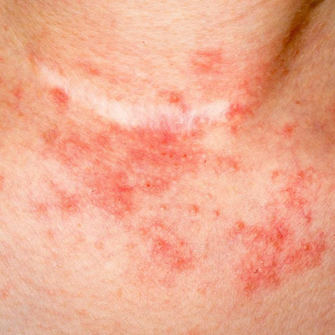 Sensitive Skin