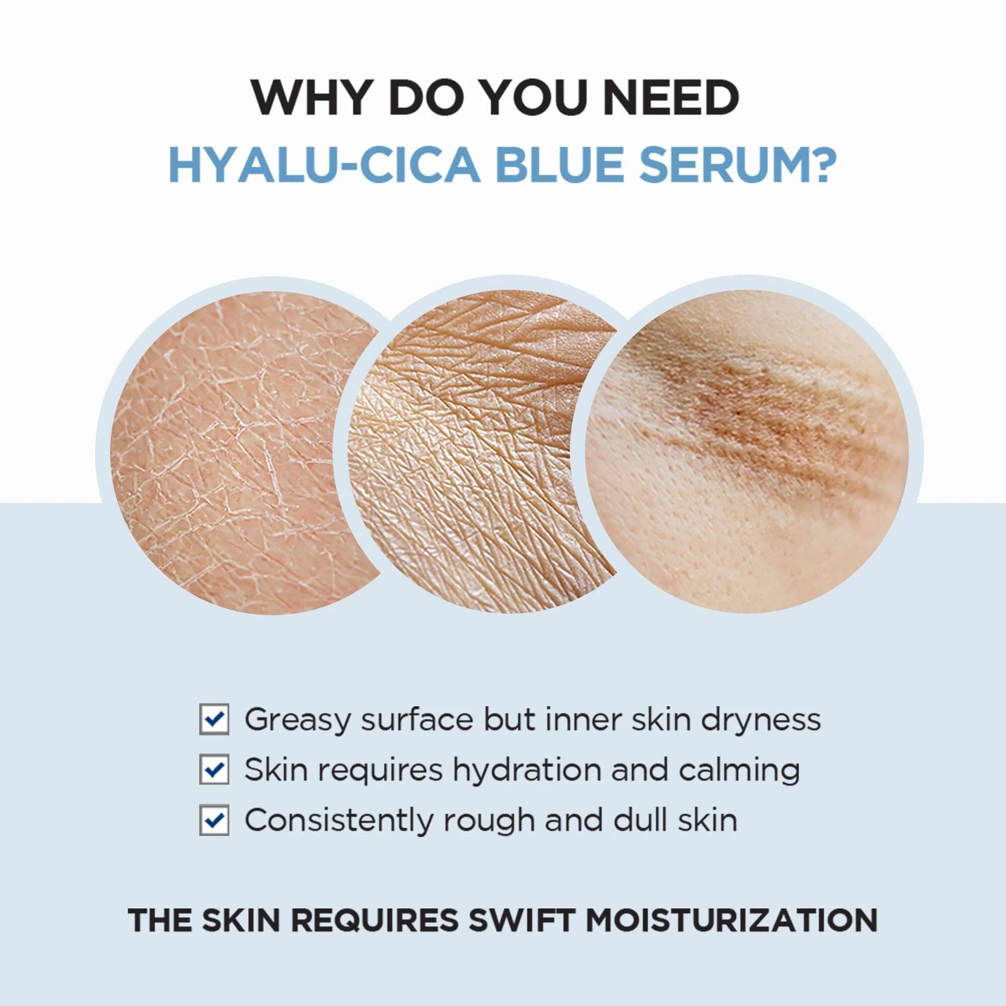 SKIN1004 Madagascar Centella Hyalu-Cica Blue Serum 50ml - Orion Beauty